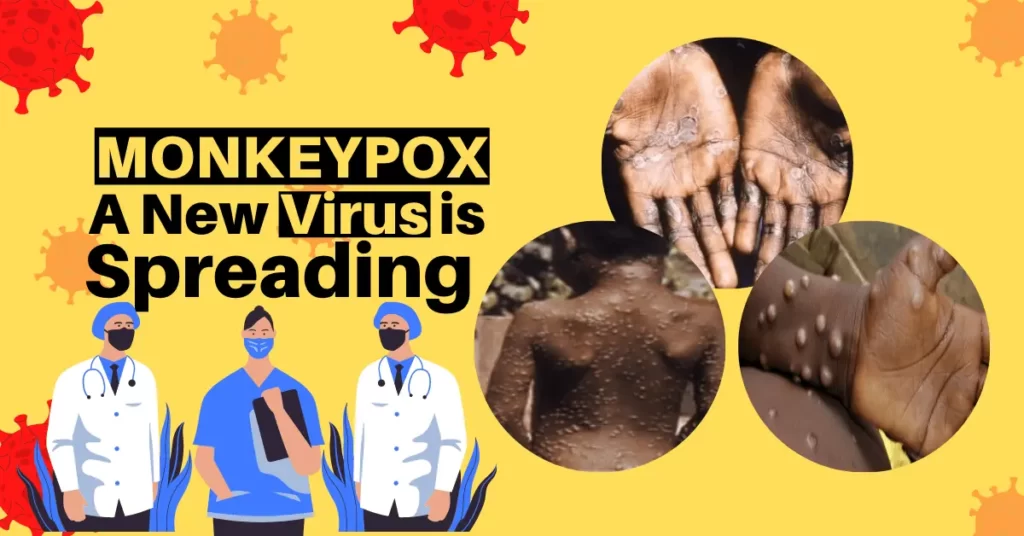 What is Monkeypox and how severe it is?